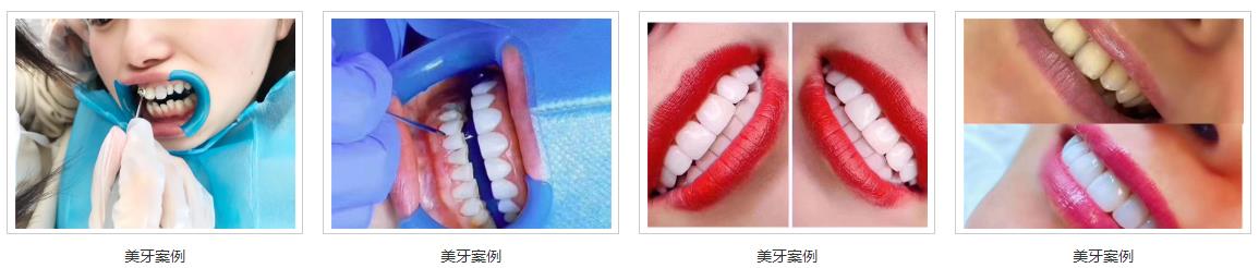 美牙案例 美牙案例