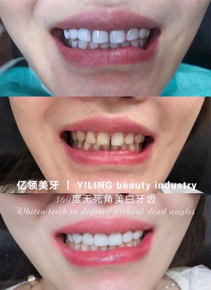 哈尔滨瓷贴面美牙培训学校排行榜单一览 哈尔滨瓷贴面美牙培训学校排行榜单一览