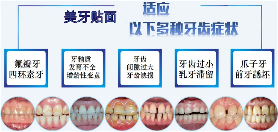 三大牙齿贴面美牙培训机构实力排名推荐-美邦铭心 三大牙齿贴面美牙培训机构实力排名推荐-美邦铭心