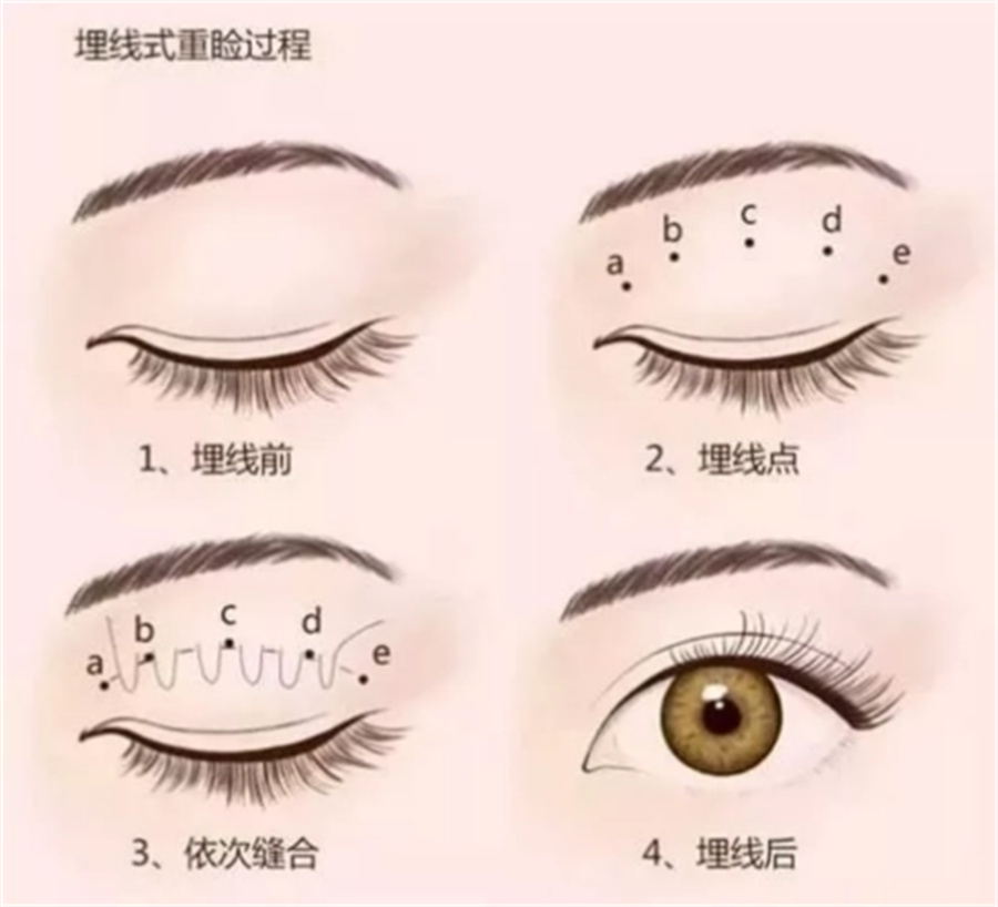 广州十大正规微整形双眼皮埋线技术培训机构排名名单-专业轻医美培训