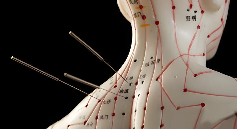 针灸培训 针灸培训